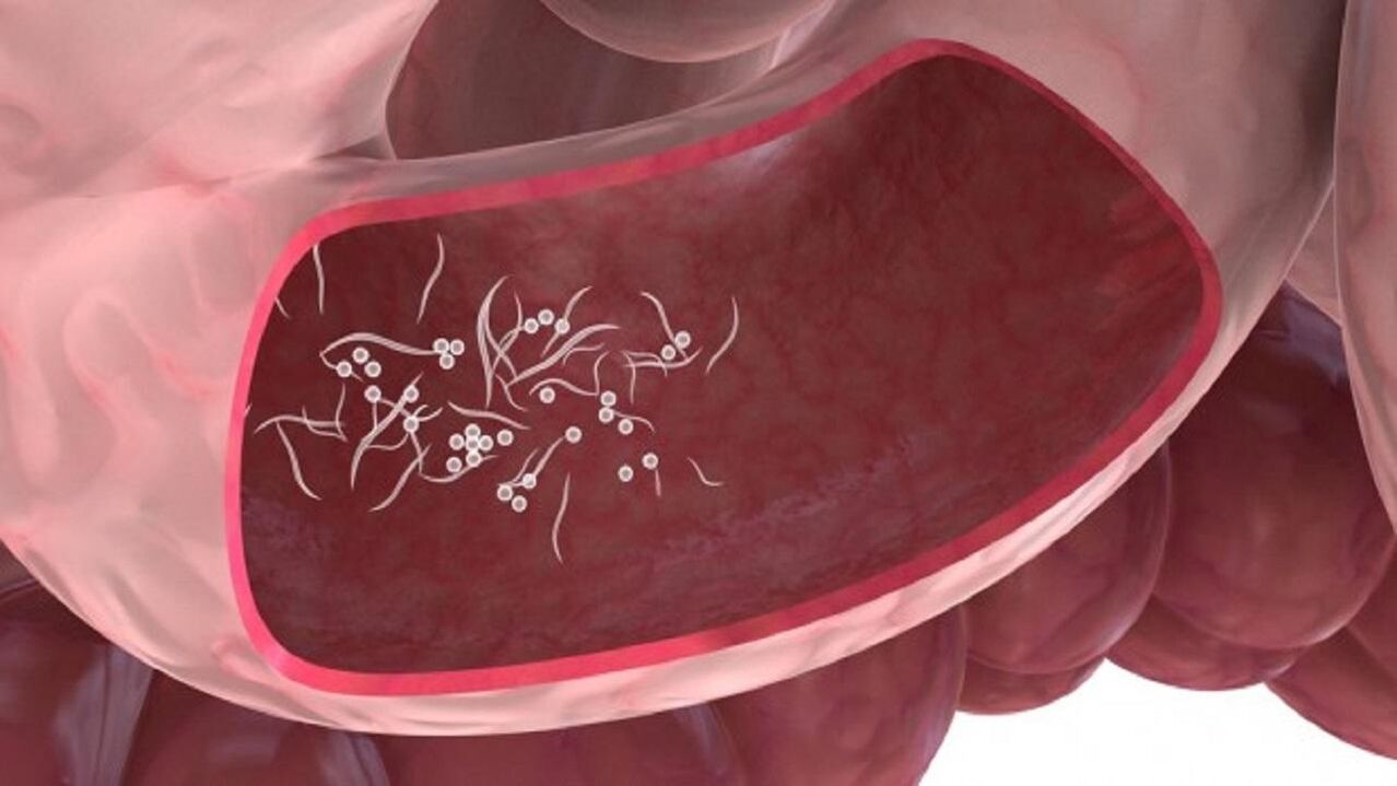 Giardia-Parasiten in der Leber.